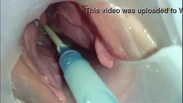 Hotte Sperm injected into the uterus of the wife of others varme filmer