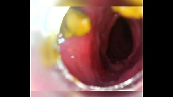Hot Endoscope withdraw after deep insertion warm Movies