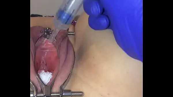 Nóng How to insert catheter into female bladder Phim ấm áp