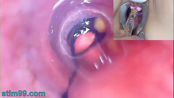 Nóng Mature Woman Peehole Endoscope Camera in Bladder with Balls Phim ấm áp