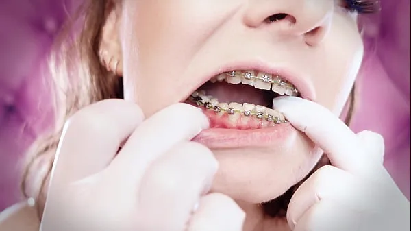 Hete ASMR: upgraded braces with chain-link rubber bands and nitrile gloves (Arya Grander warme films